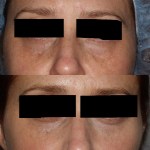 Before and after Tear Trough Fillers