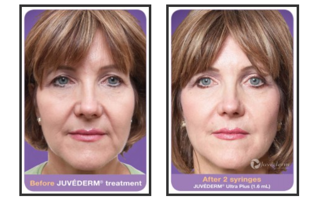 Before and after Juvederm