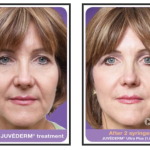 Before and after Juvederm