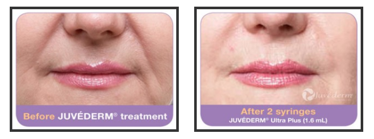 Before and after Juvederm