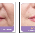 Before and after Juvederm
