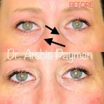 Before and after Tear Trough Fillers