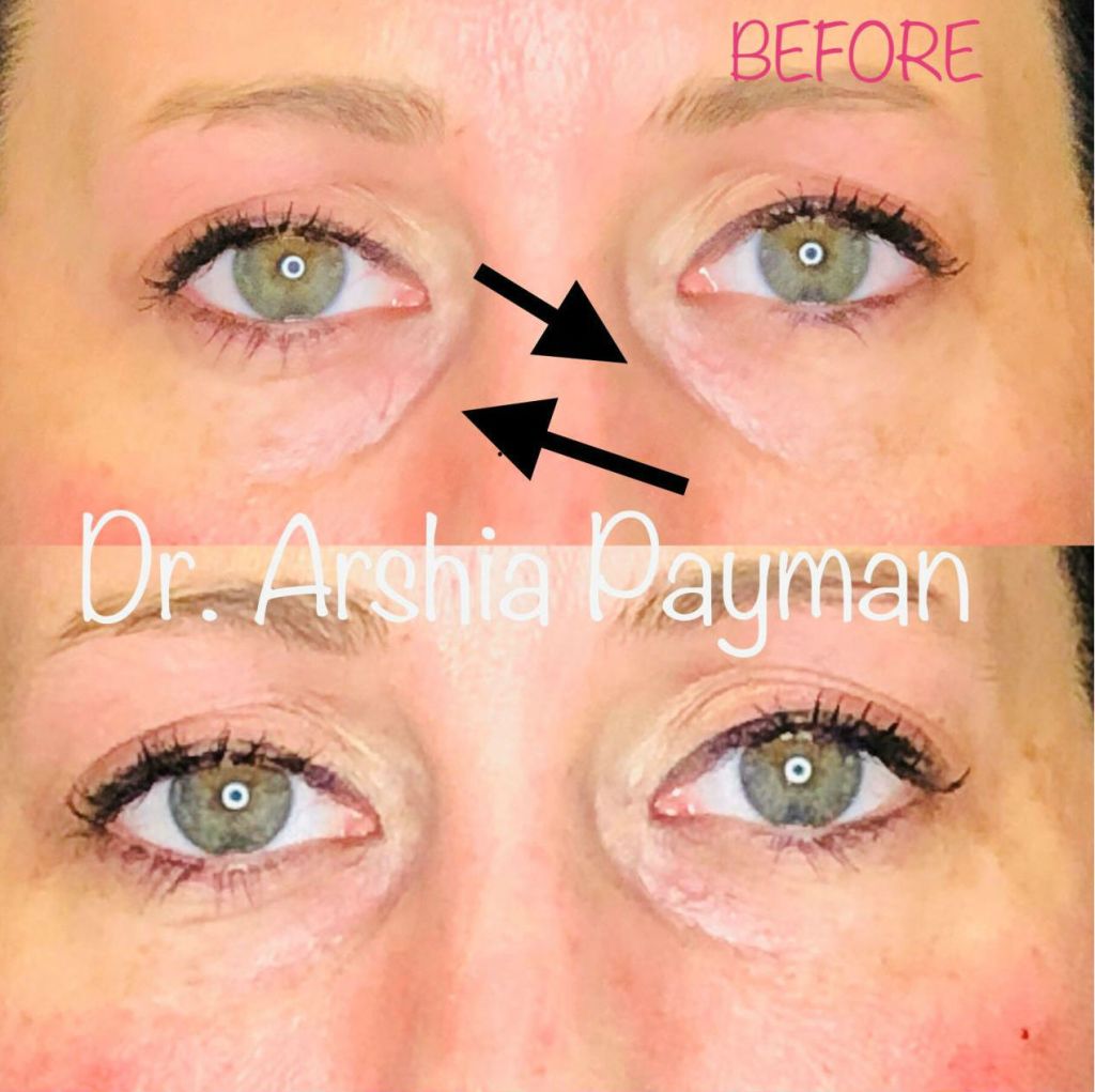 Before and after Tear Trough Fillers