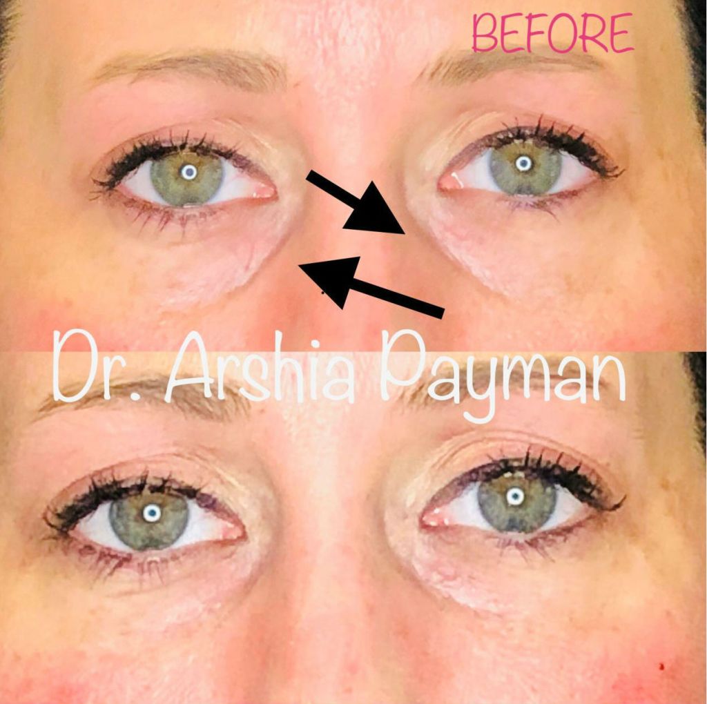 Before and after Tear Trough Fillers