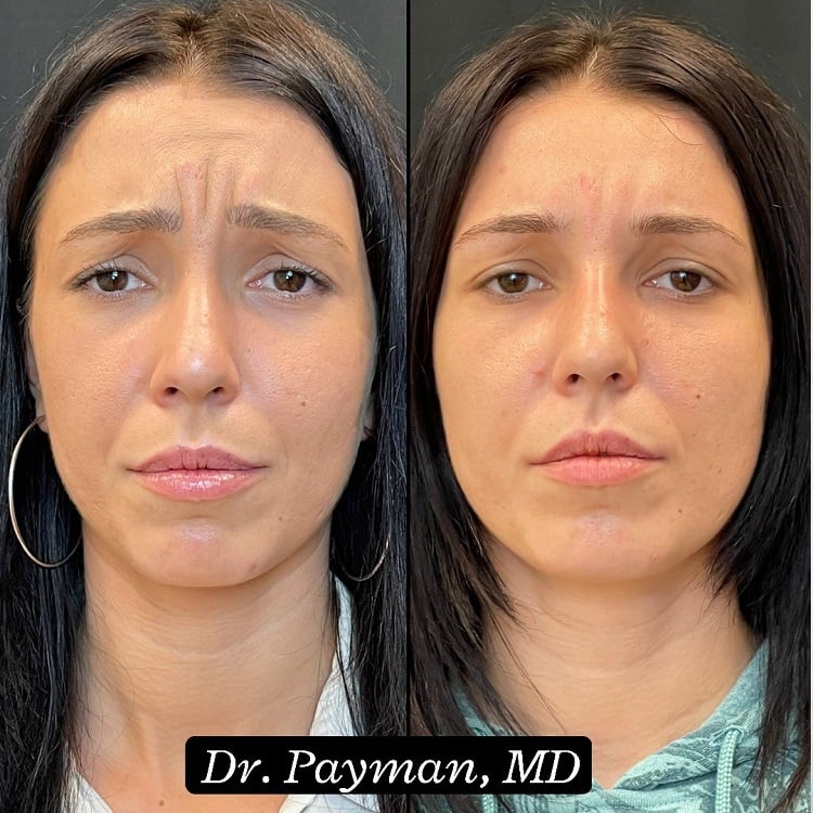 Botox Glabella before and after images