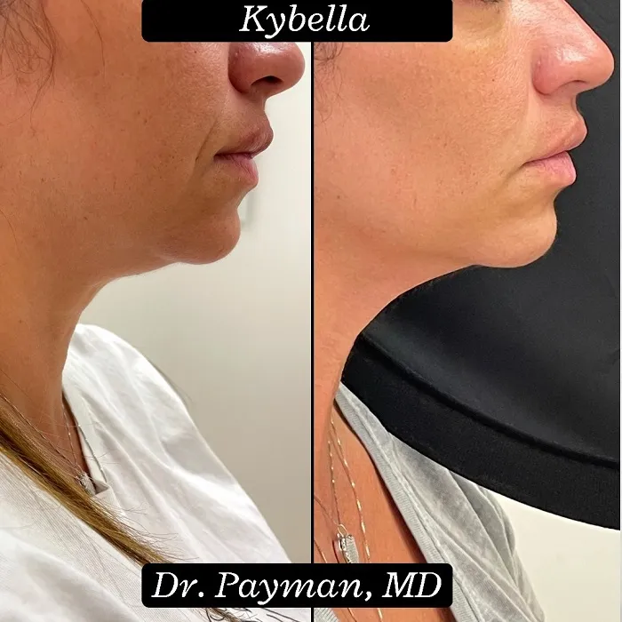 Profile before and after images of a chin that has been slimmed down