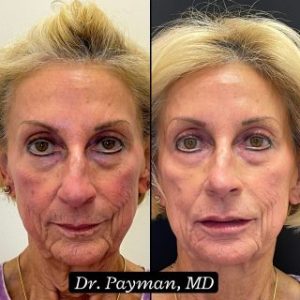 Cheek & Marionnet Filler before and after images