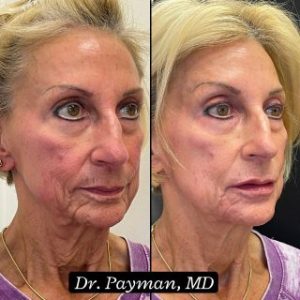 Cheek & Marionnet Filler before and after images
