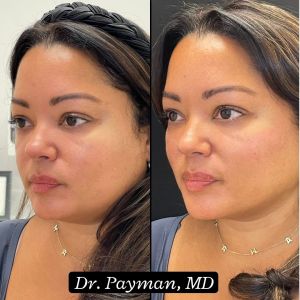 Cheek Filler before and after images