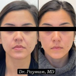 Botox & Dermal Filler before and after images