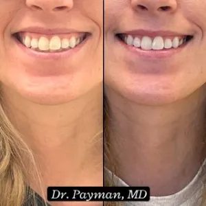  Botox – Gummy Smile before and after images