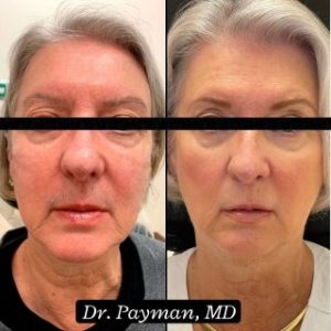 Dermal Filler before and after images