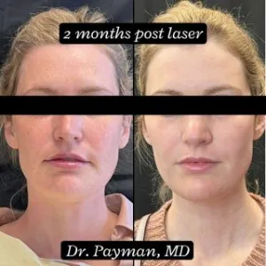 Before and after images of a woman who received Skin Resurfacing from Dr. Payman