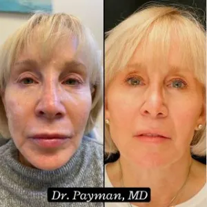  Botox & Dermal Filler before and after images