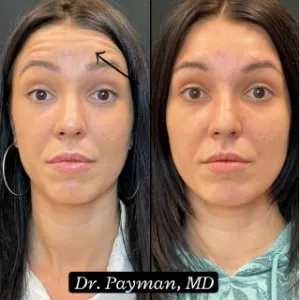 Botox Forehead before and after images
