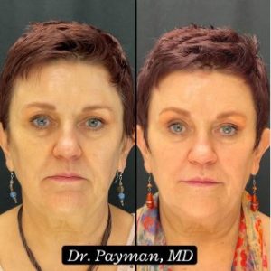  Botox & Dermal Filler before and after images