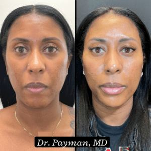 Cheeks, Chin, & Lips before and after images