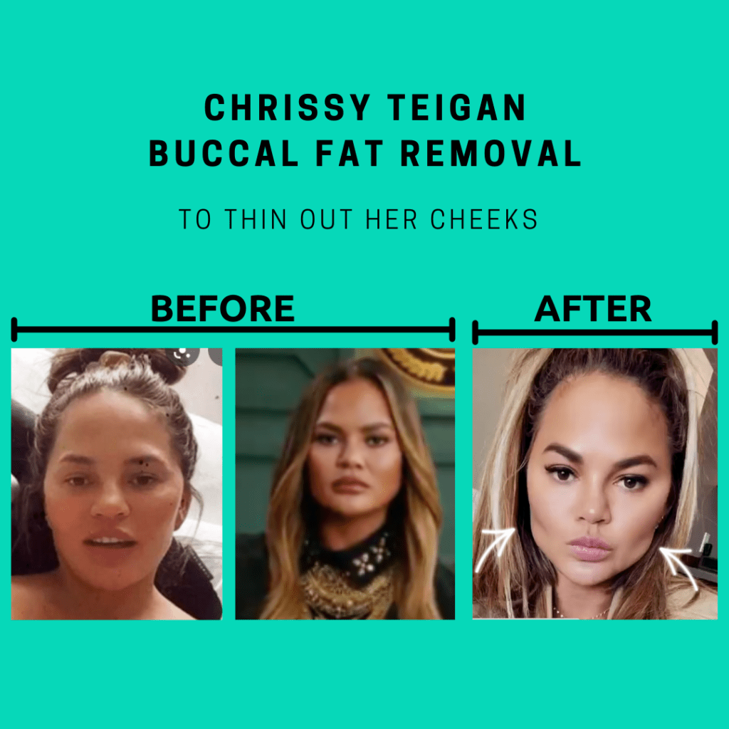 Buccal Fat Removal Atlanta GA