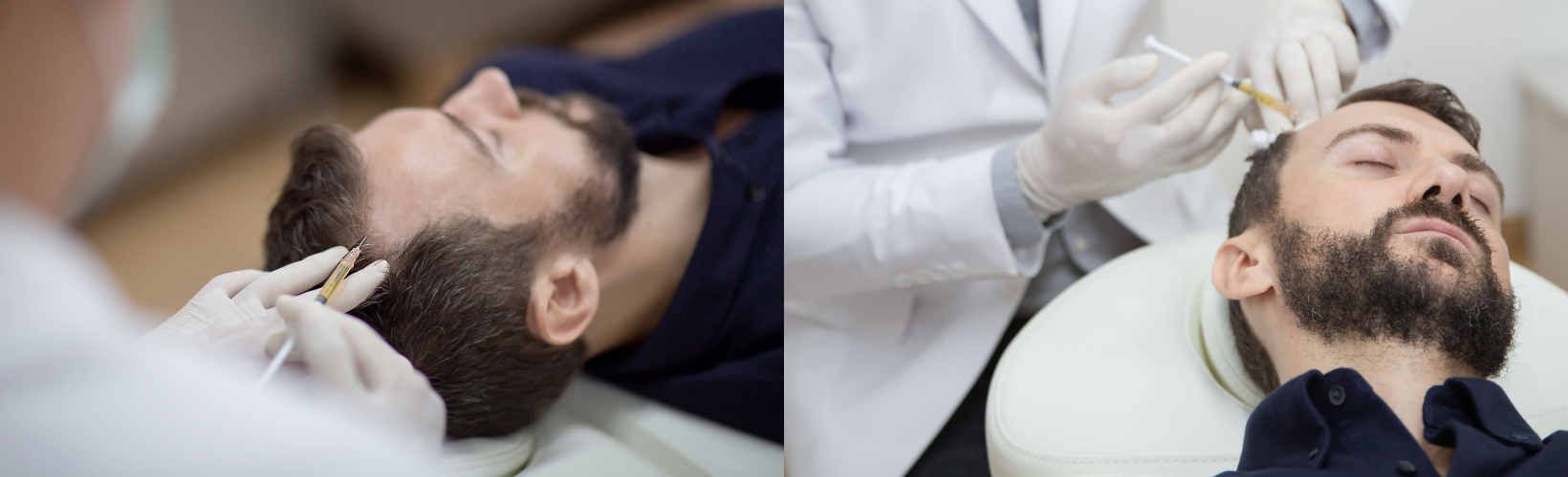 PRP Hair restoration in process