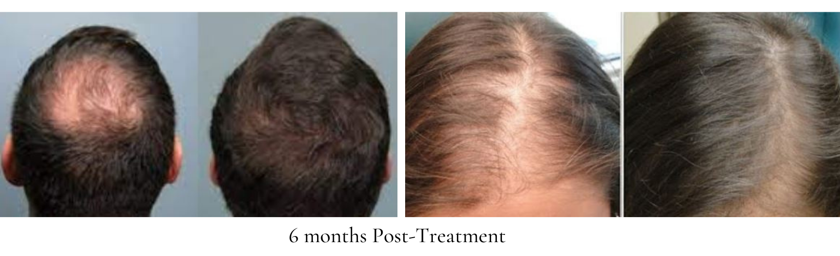 Before and after images of the top of a mans head