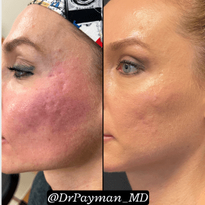 A profile before-and-after comparison showing a dramatic reduction in deep, pitted acne scars and facial redness on the cheek; the after photo shows a much smoother and more even skin surface