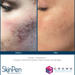 Before and After Skin Pen Microneedling