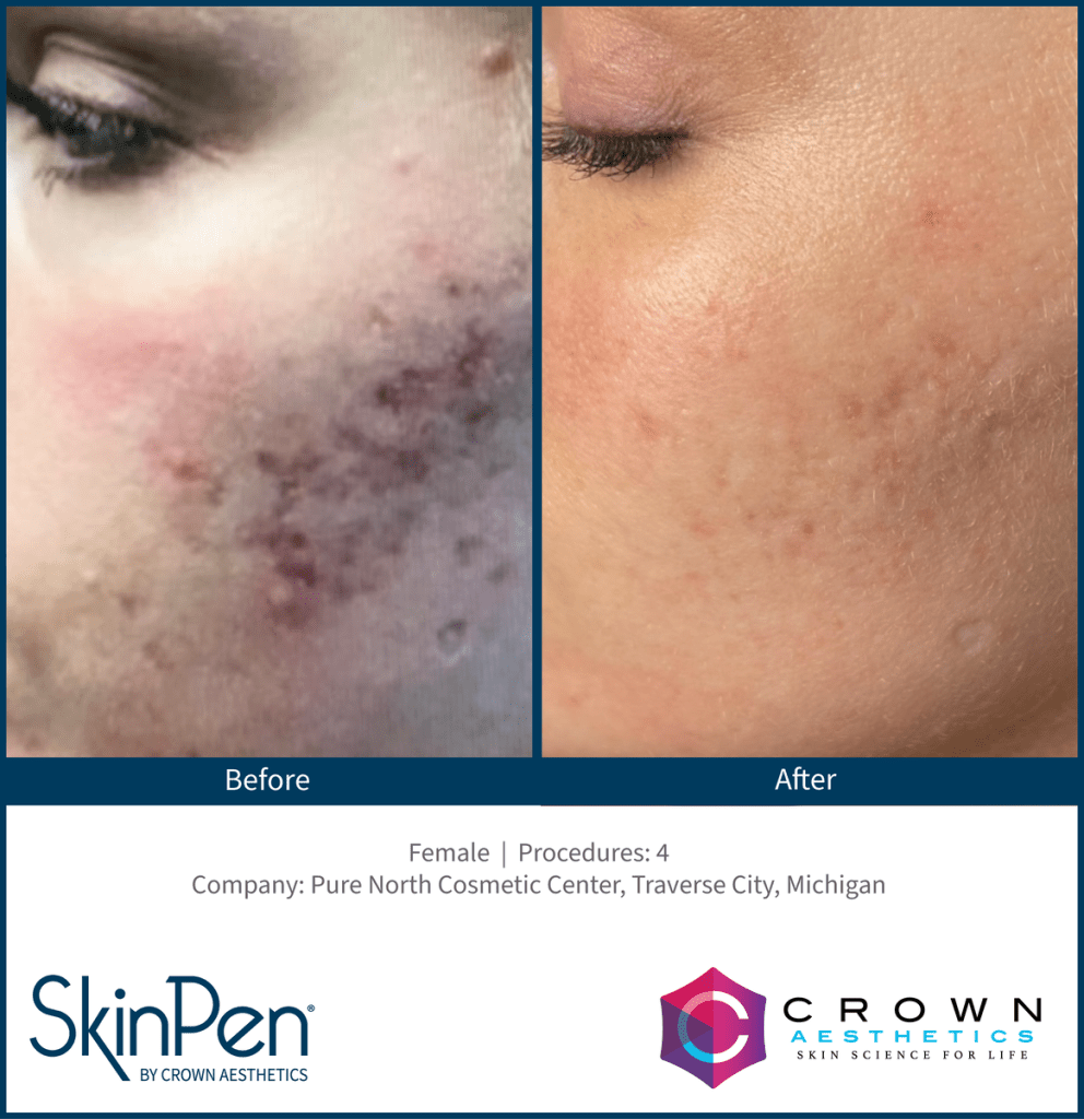 Before and After Skin Pen Microneedling