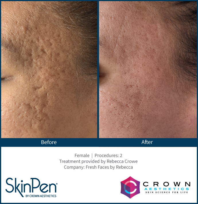 Before and After Skin Pen Microneedling
