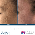 Before and After Skin Pen Microneedling