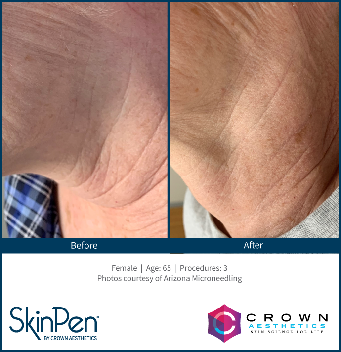 Before and After Skin Pen Microneedling