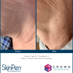 Before and After Skin Pen Microneedling