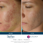 Before and After Skin Pen Microneedling