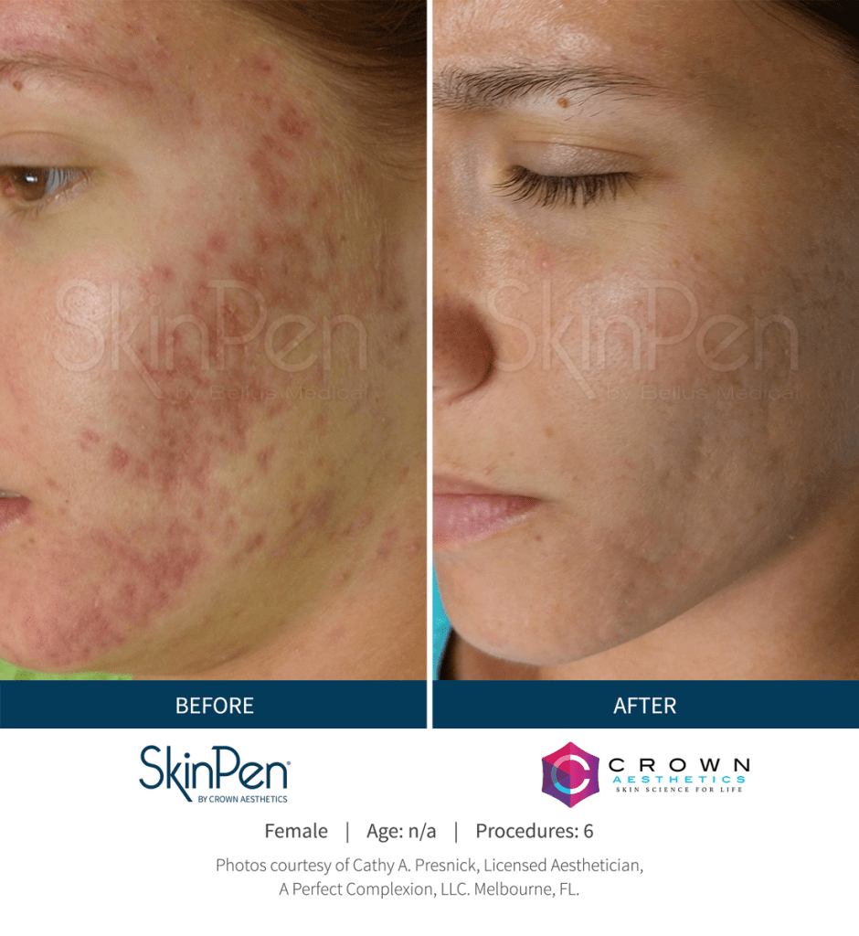 Before and After Skin Pen Microneedling