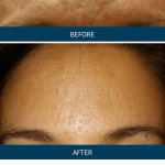 Before and After Skin Pen Microneedling
