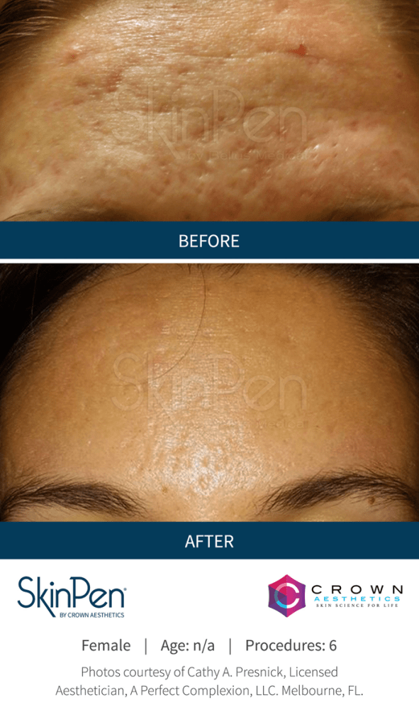 Before and After Skin Pen Microneedling