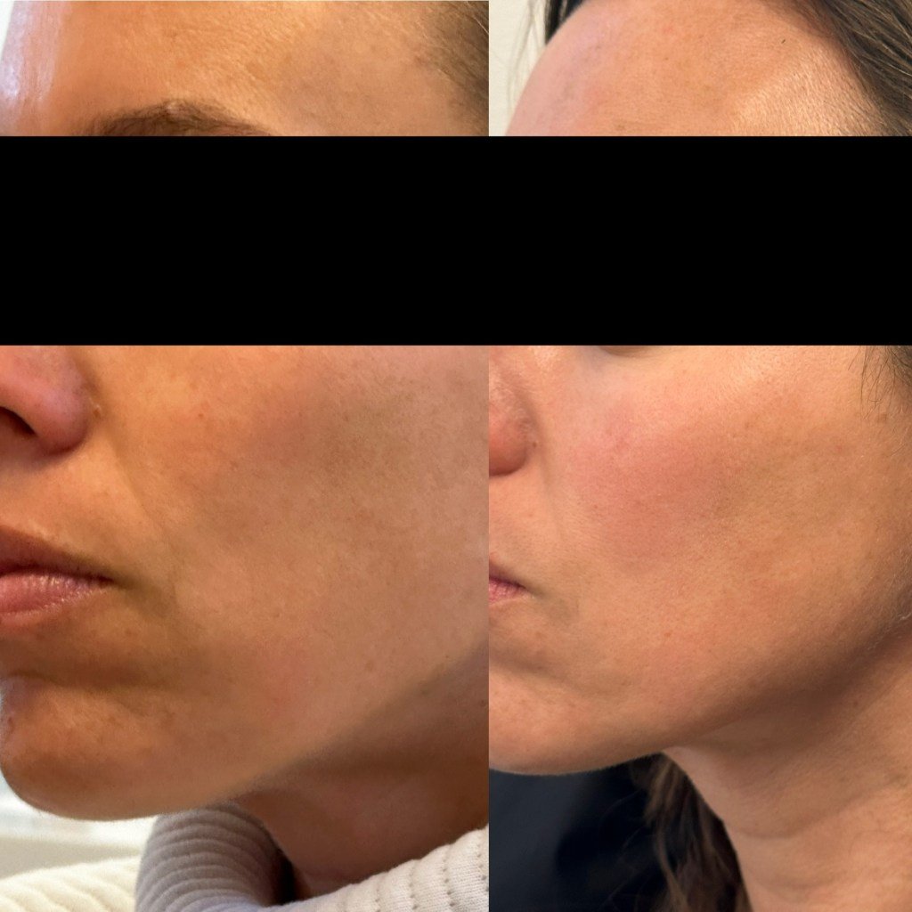 Skinvive before and after photos
