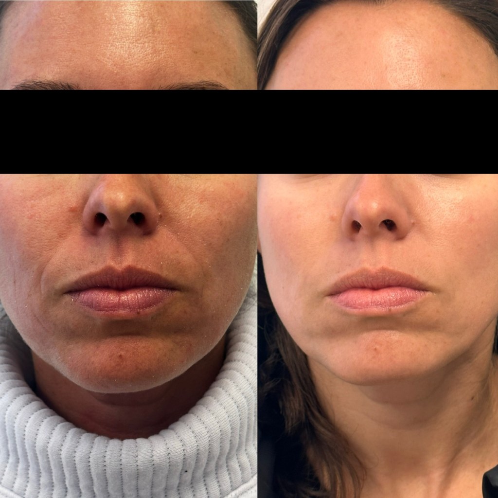 Skinvive before and after photos