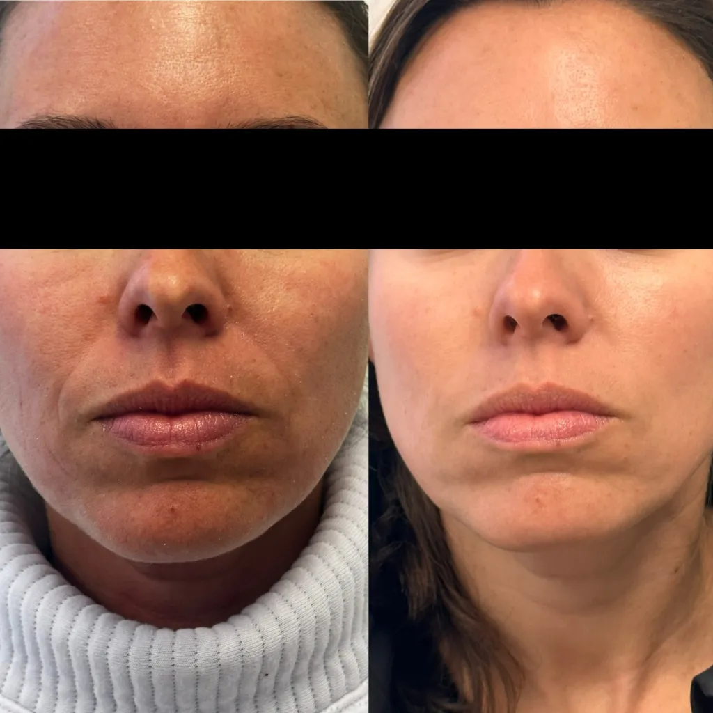 Skinvive before and after photos