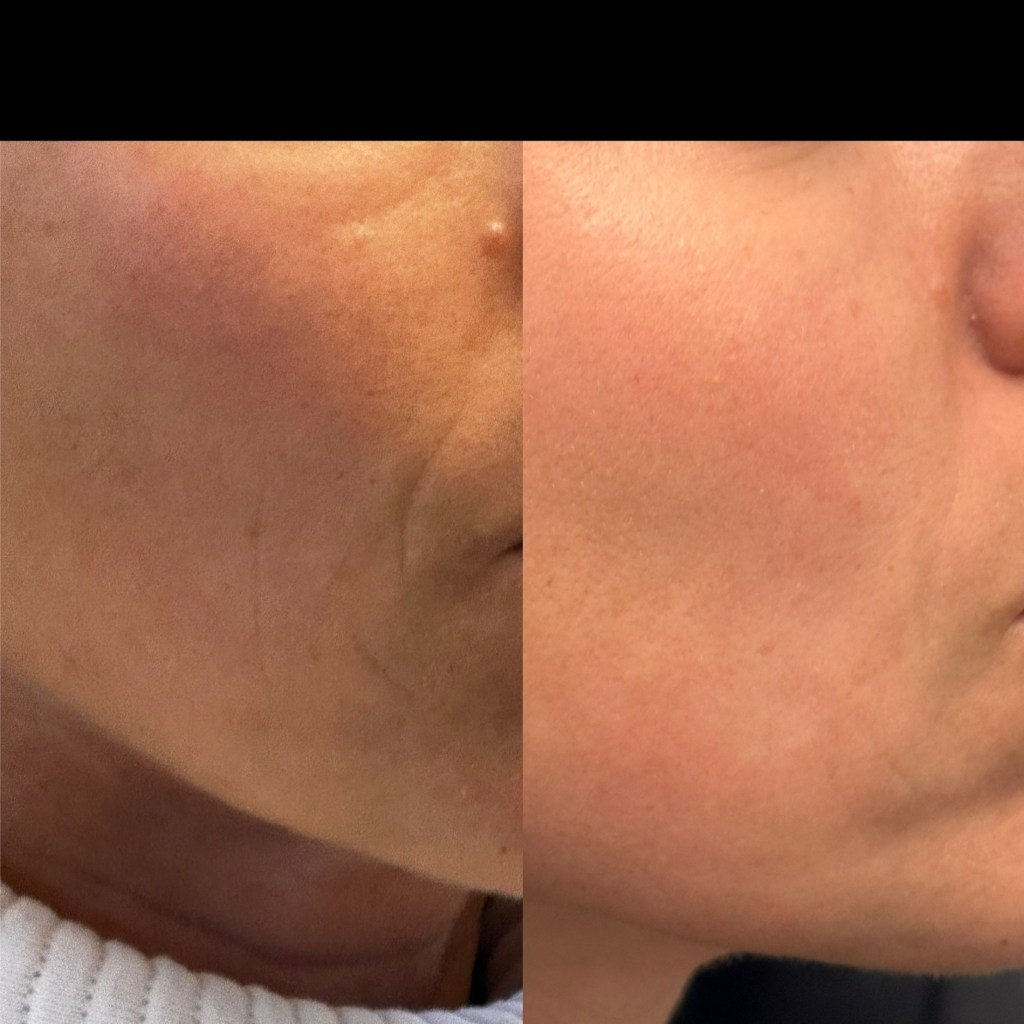 Skinvive before and after photos