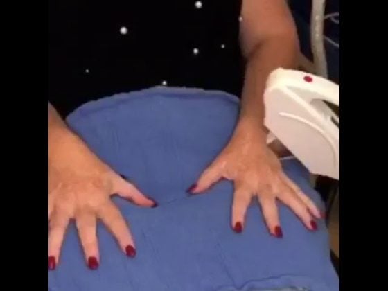 Hand rejuvenation with Intense Pulse Light Therapy thumbnail