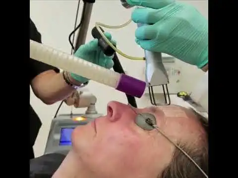 Laser resurfacing procedure thumbnail