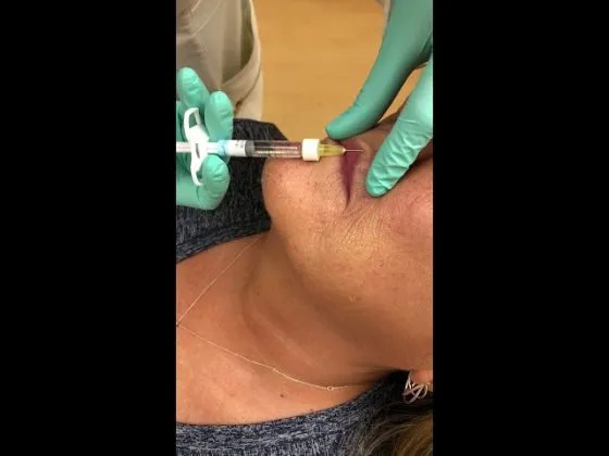 Lip lines treated with fillers thumbnail