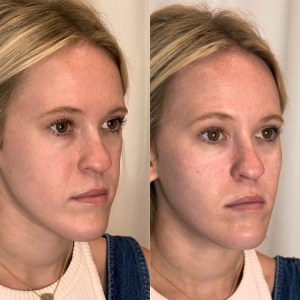 A second instance of the angled facial rejuvenation comparison