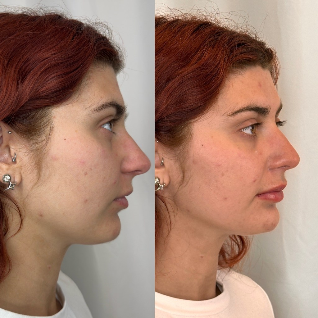 View from below the chin showing a smoother, tighter neck area