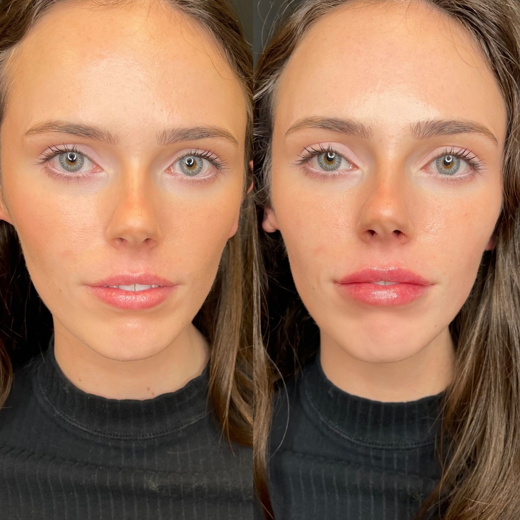 Final frontal comparison showing a subtle lift to the corners of the mouth and a brighter overall complexion