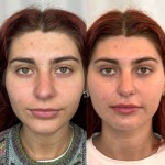Frontal view of a woman showing more defined cheek contours and a smoother chin area