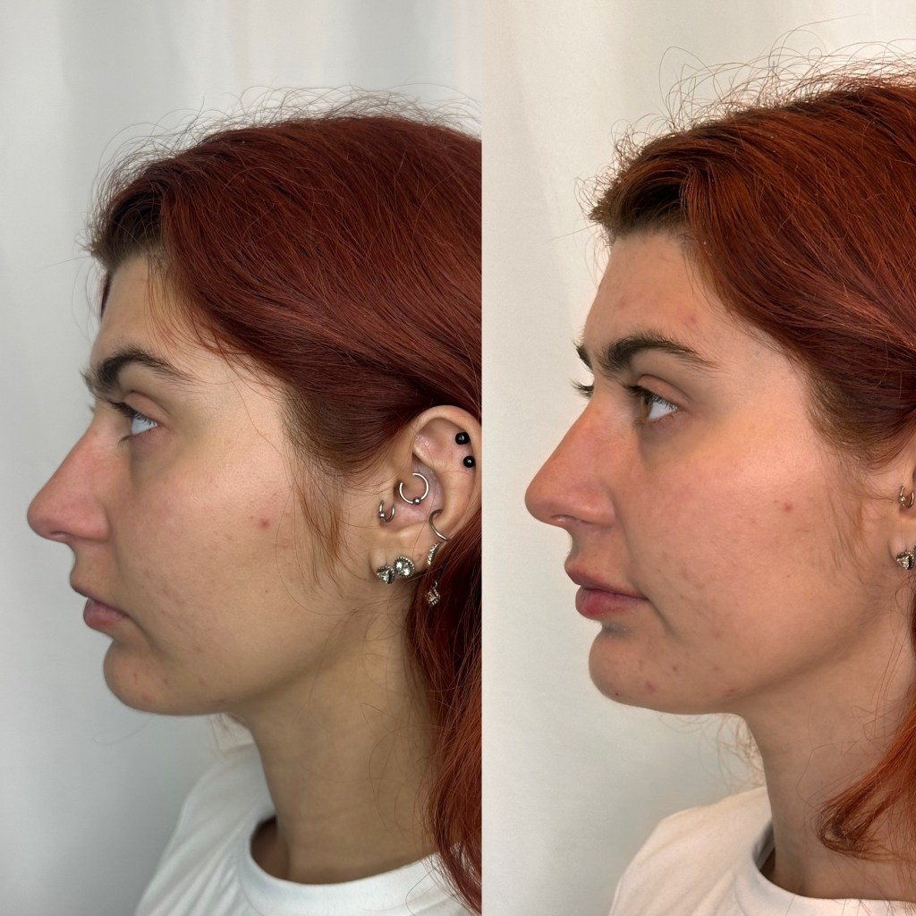 Side profile view focusing on a more defined and 