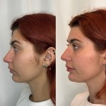 Side profile view focusing on a more defined and 